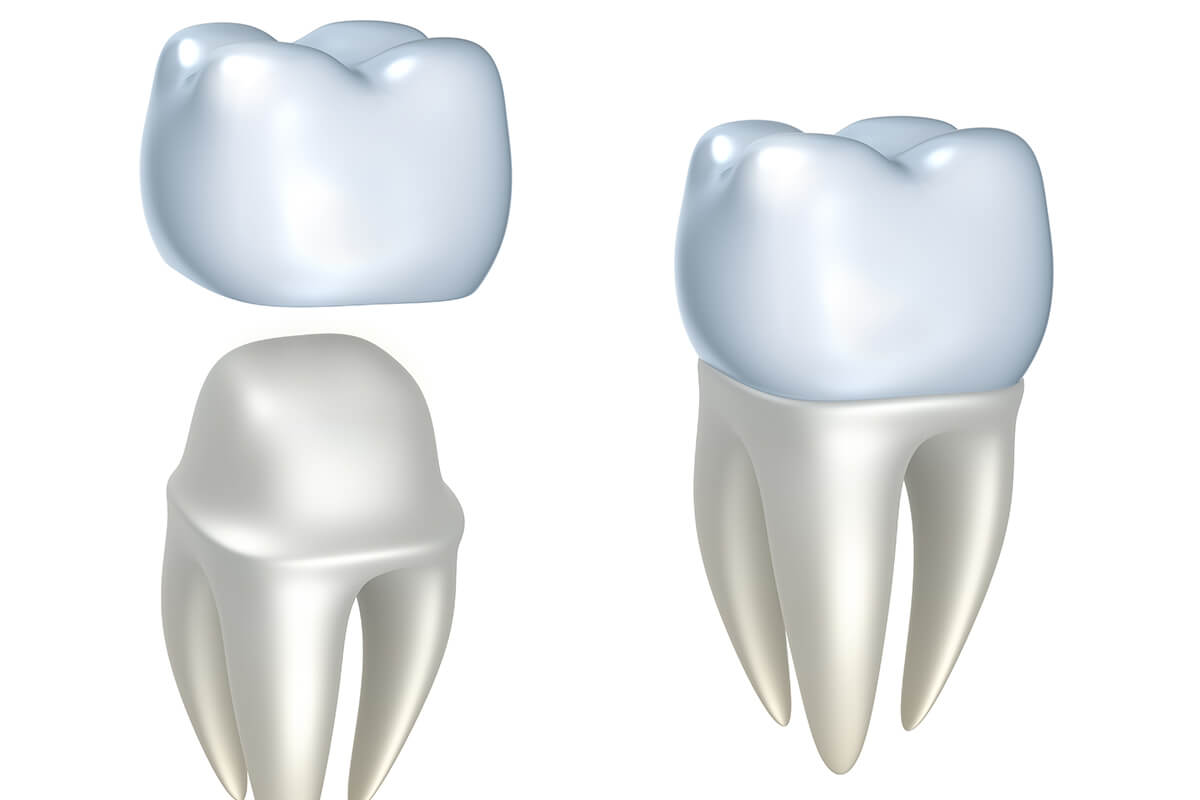 New Crowns for Teeth in Jackson NJ Area